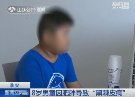 儿童肥胖黑棘(儿童肥胖黑棘皮病吃二甲双胍)