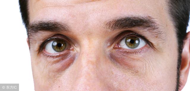 黑眼圈三大类你属于哪种，你知道你的黑眼圈属于哪种类型吗