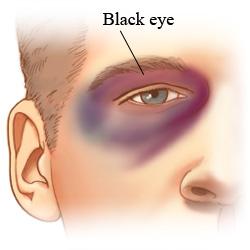 黑眼圈三大类你属于哪种，你知道你的黑眼圈属于哪种类型吗