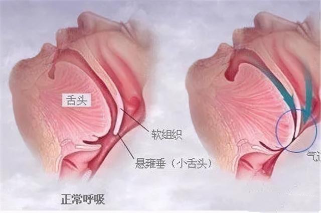 高血压引起的脑出血急救方法，高血压引起的出血性脑中