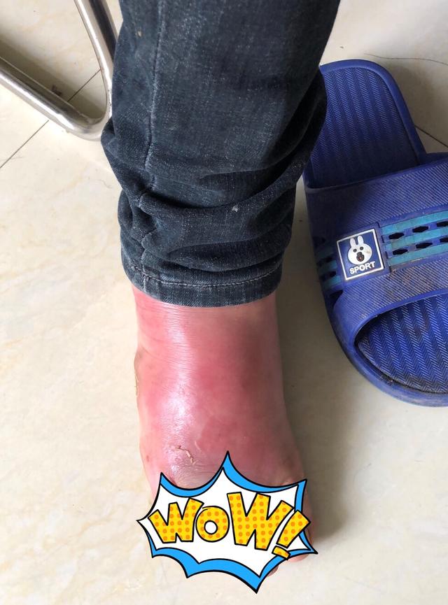 糖尿病脚烂图片(糖尿病脚烂图片 轻微)