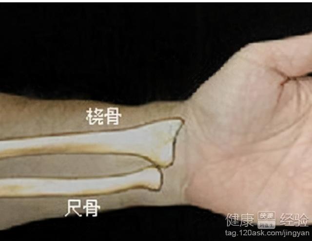 桡骨远端骨折分型，桡骨远端骨折有哪些分型（桡骨远端骨折的AO分型）