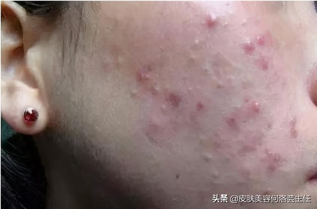 肥胖纹刷酸(肥胖纹可以通过涂抹淡化吗)