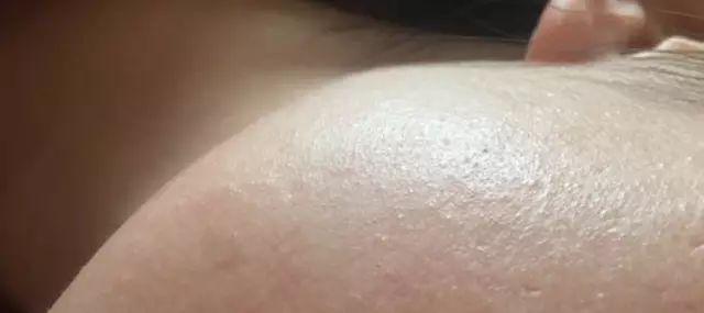 逆光疹会自愈吗，逆光疹开始变好的征兆（易混淆闭合性粉刺、皮脂腺增生）