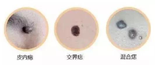 痣可以随便点吗如何正确点痣，再难看也不能随便点掉