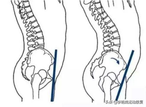骨盆前倾怎么办，骨盆前倾三种办法（3个小动作缓解你的骨盆前倾）