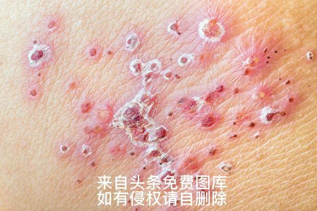 带状疱疹最好的治疗方法，带状疱疹的最佳治疗方法