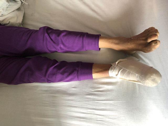 脚长水泡是糖尿病吗(脚上起小水泡很痒和糖尿病有关吗)