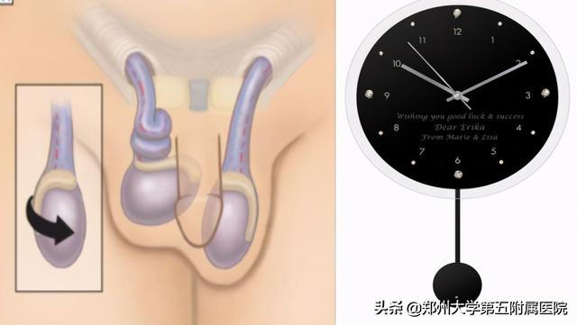 急性睾丸扭转百科，“蛋蛋”疼？小心急性睾丸扭转