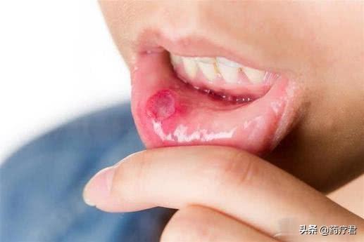 糖尿病引发口腔溃疡(糖尿病引起的口腔并发症)