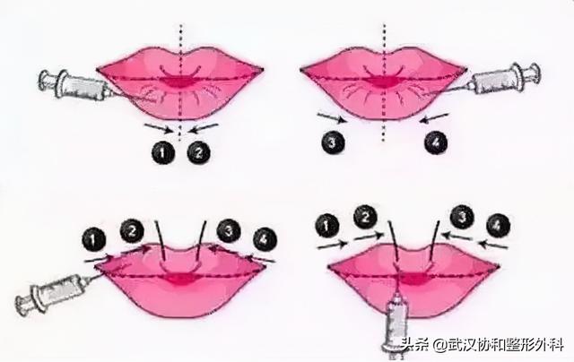 常见的唇部整形都有哪些，唇部整形有什么方法