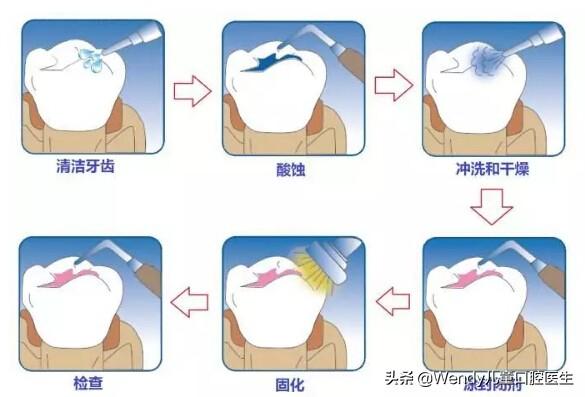 一张刷爆朋友圈的牙片，成年人要做牙齿窝沟封闭
