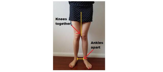 o型腿膝盖内扣怎么矫正，笔直修长美腿炼成记之