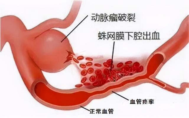 高血压引起的脑出血急救方法，高血压引起的出血性脑中