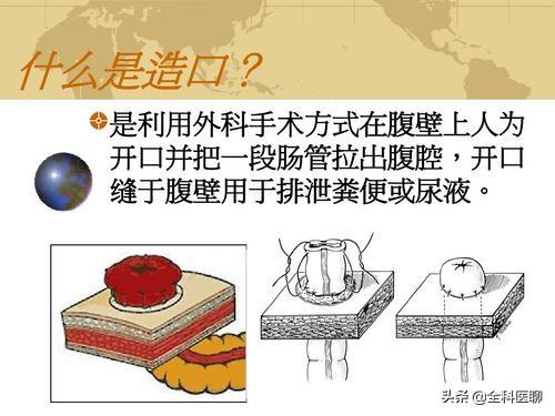肥胖造瘘(造瘘风险大吗)
