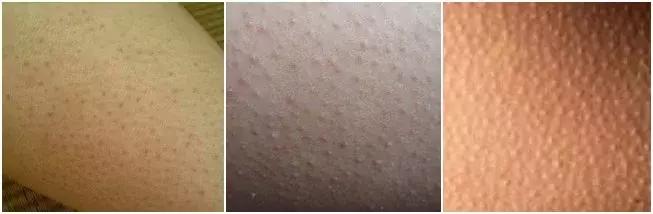 去鸡皮肤最有效的方法，去鸡皮肤的最有效方法（夏天令人讨厌的‘“鸡皮肌肤”’）