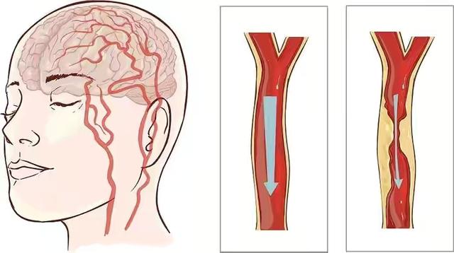 脑梗前兆有这4个征兆，这4种异常或是前兆