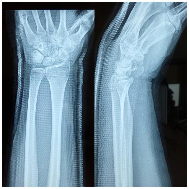 桡骨远端骨折分型，桡骨远端骨折有哪些分型（桡骨远端骨折的AO分型）