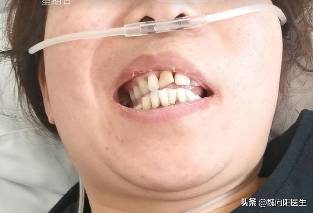 主妇型肥胖