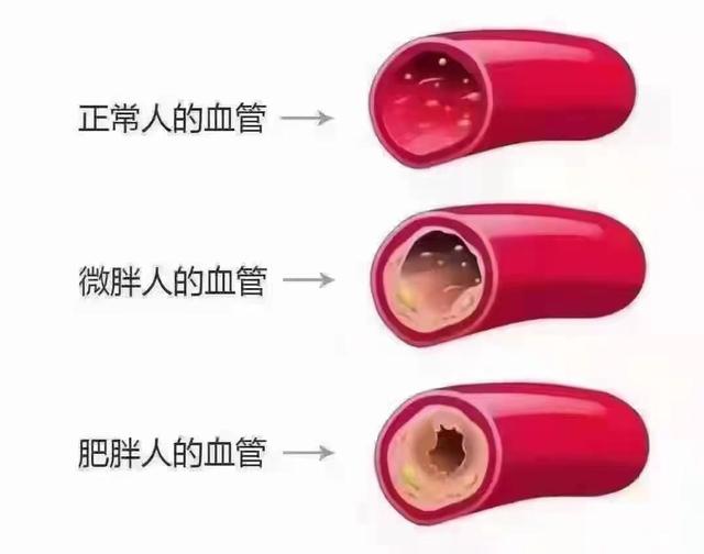 正常人和肥胖人血管(正常人和肥胖人的基础代谢相差大吗)