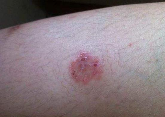 猫藓应该怎么治疗，猫藓为什么难根治