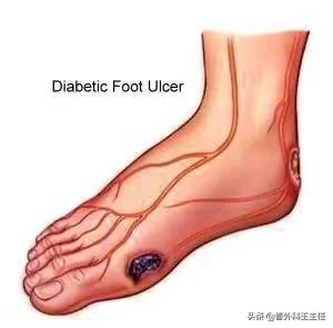 糖尿病足底干(糖尿病足底干裂烂一个洞不愈合)