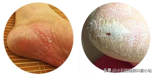 治疗足癣最快最好的办法是什么，用醋泡脚能摆脱足癣吗