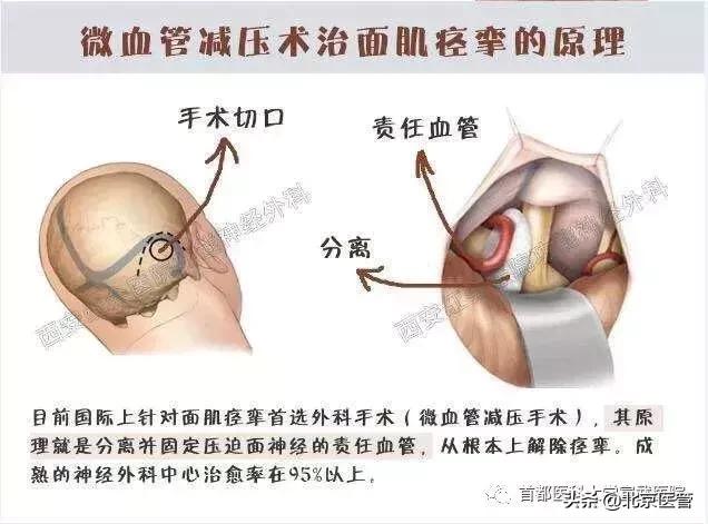 左眼皮上眼皮跳的预兆，民间说“左眼跳财