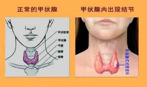 最新甲状腺tirads分级标准，一图看懂甲状腺TI-RADS分级