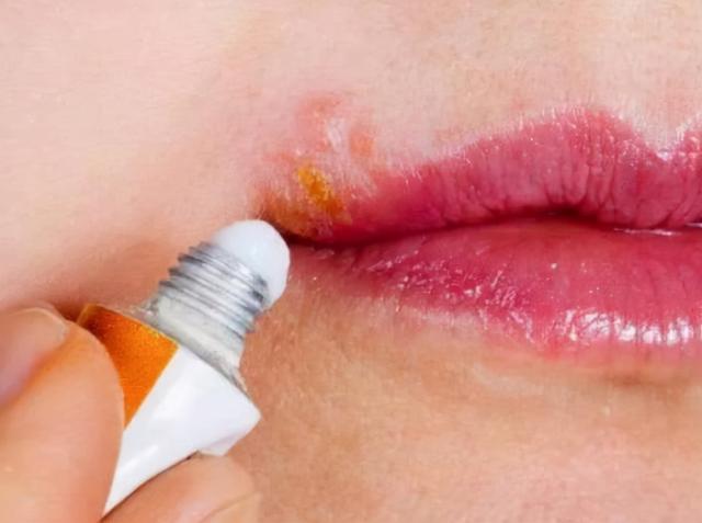 红霉素软膏的禁忌，红霉素软膏的功效及注意事项