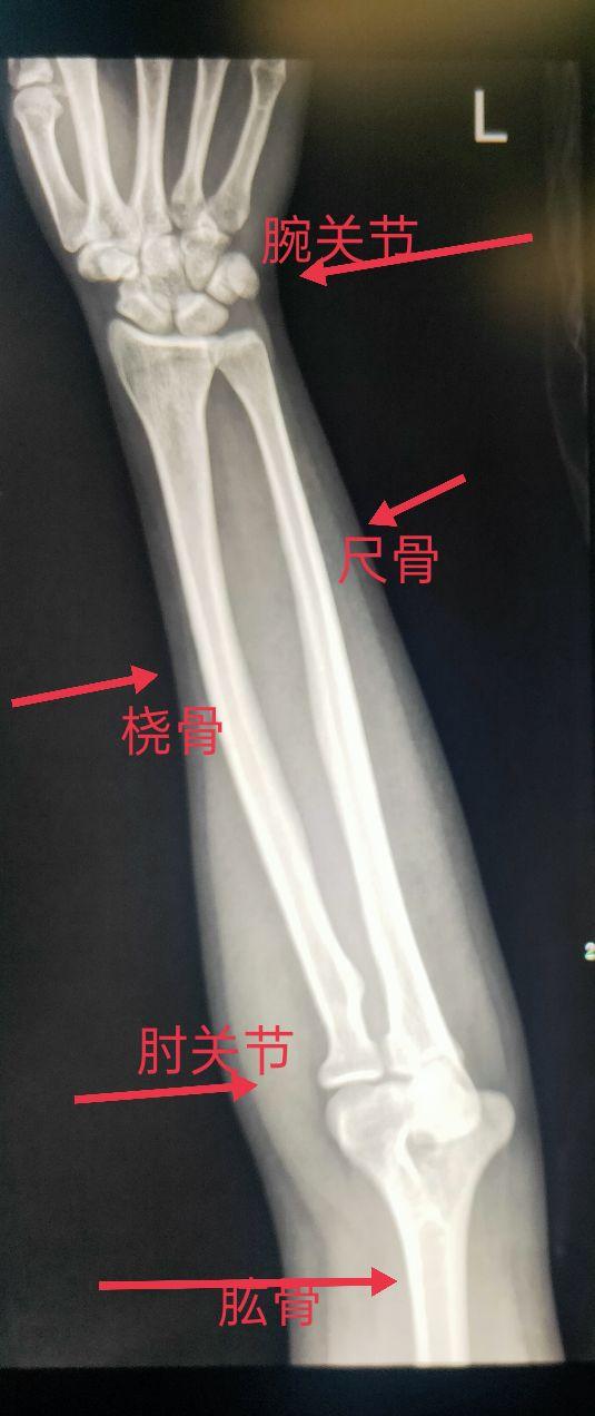 尺桡骨正侧位x线片，学习X线读片指南骨
