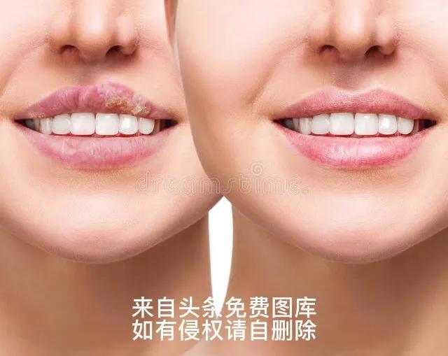 带状疱疹最好的治疗方法，带状疱疹的最佳治疗方法