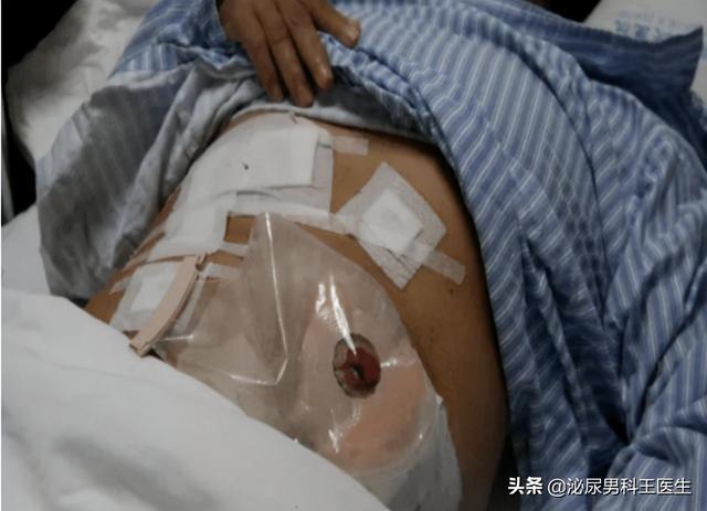 什么情况下要人造肛门，我国“造口人”超百万