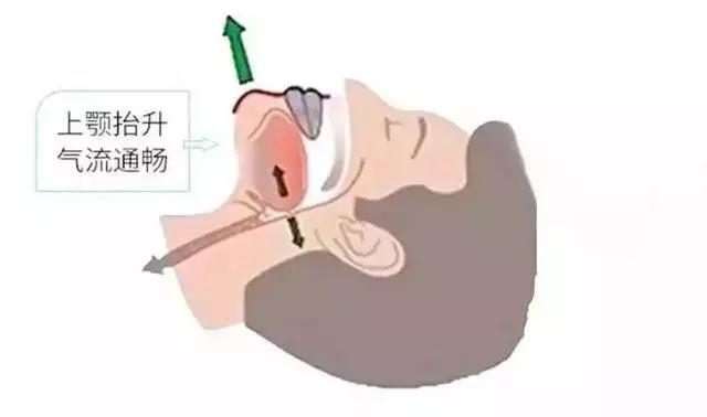 民间止鼾九大妙招，教你一招永不打呼噜小妙招