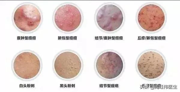 一分钟教你分辨痘痘类型，1分钟教会你认清痘痘类型