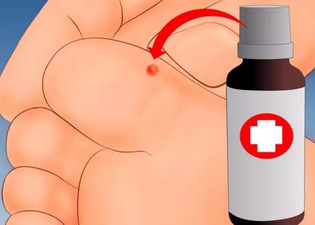 瘊子可以自己去掉吗，瘊子会自己消失不用治