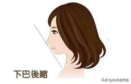 怎么判断下巴是否后缩，最容易下巴后缩的两点原因