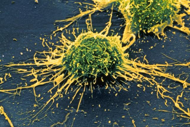 阿尔茨海默症的五个真相，要警惕是阿尔茨海默病