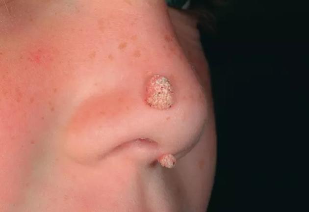 瘊子可以自己去掉吗，瘊子会自己消失不用治