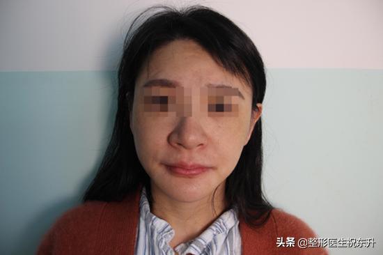 肥胖法令纹深(法令纹变胖就能消失吗)