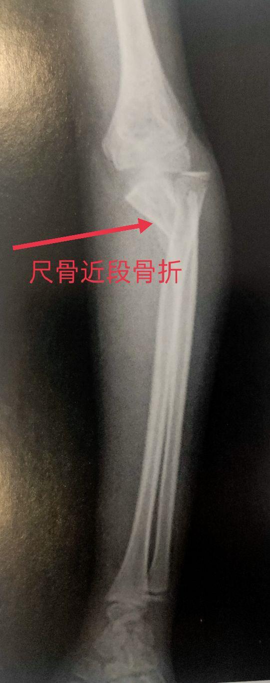 尺桡骨正侧位x线片，学习X线读片指南骨