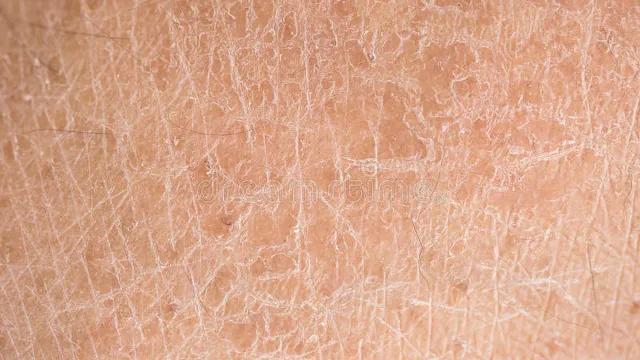 腿上有白色的皮屑，冬天腿上有白色的皮屑