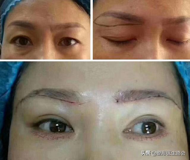 膨体填充泪沟失败案例，小助理欢欢同你聊一聊