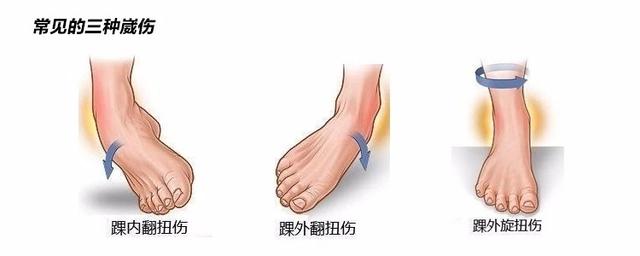 为什么总是习惯性崴脚，习惯性崴脚，做对四步即可