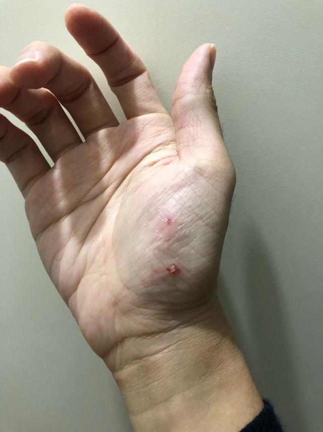 狗咬糖尿病(狗糖尿病好治吗)
