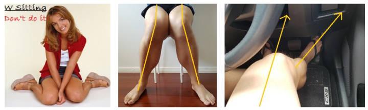 o型腿膝盖内扣怎么矫正，笔直修长美腿炼成记之