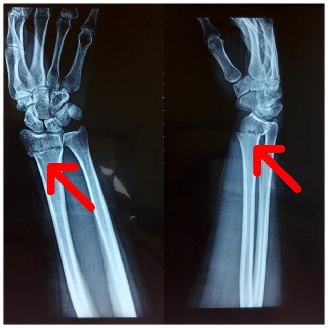 桡骨远端骨折分型，桡骨远端骨折有哪些分型（桡骨远端骨折的AO分型）