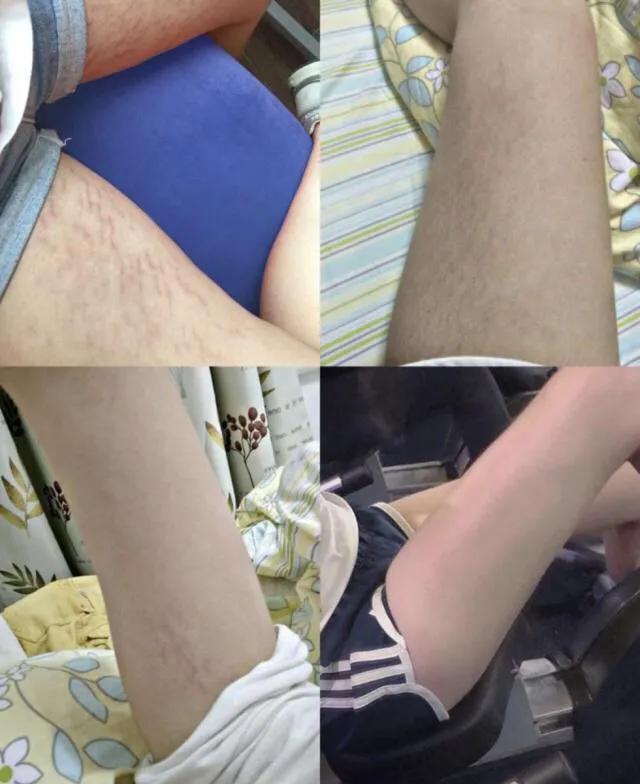 去除肥胖纹手术价格(肥胖纹祛除手术需要多少钱)