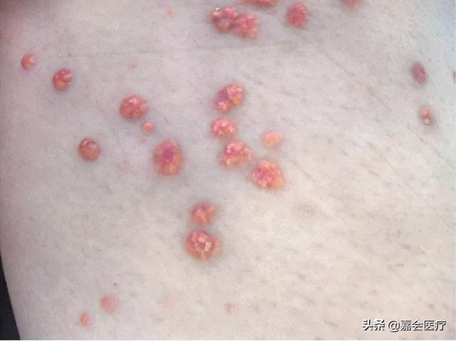 大腿淤青糖尿病(糖尿病人腿碰青了怎么办)