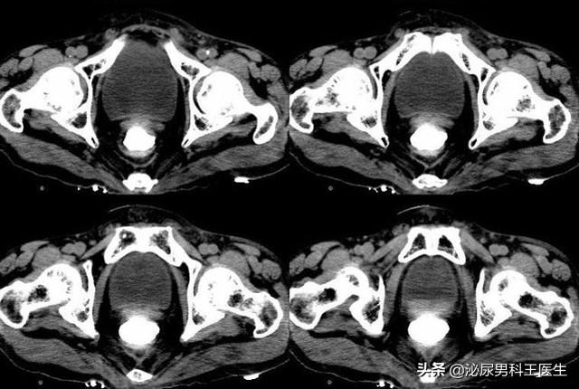 什么情况下要人造肛门，我国“造口人”超百万